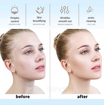 Fast-Acting Acne-Clearing Wand - Blemish & Pimple Treatment