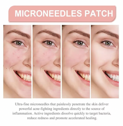 Hydrocolloid Pimple Patches – Invisible Acne Dots