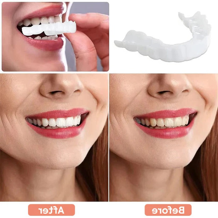 Natural White Cosmetic Veneers for Teeth