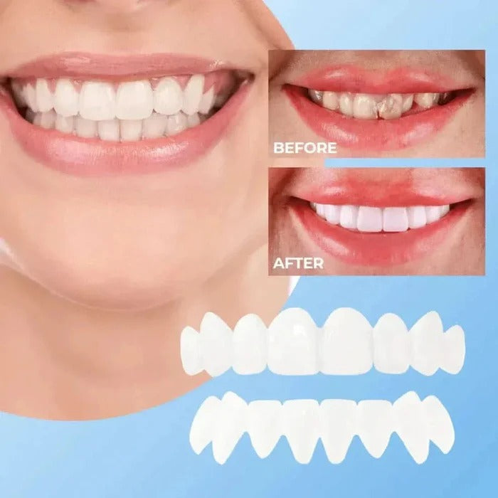 Natural White Cosmetic Veneers for Teeth